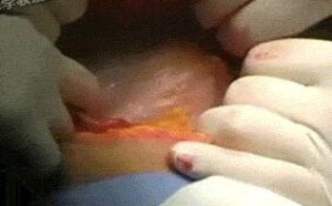女人生孩子剖腹产全过程gif动态图片欣赏